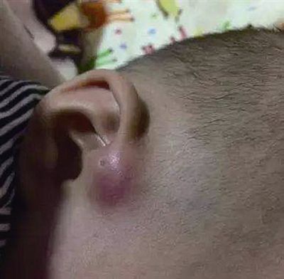 孩子耳朵旁边长了个聪明孔,婴幼儿耳朵长出聪明孔