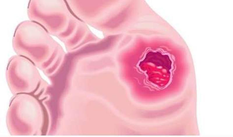 糖尿病的并发症信号,糖尿病并发症的信号是什么