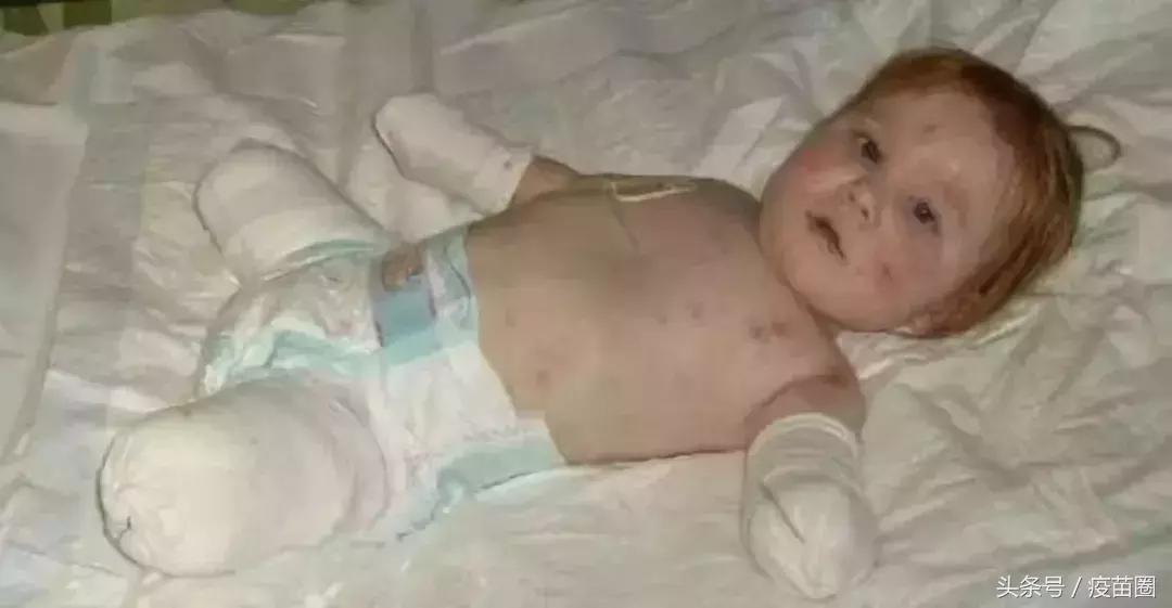 b型流感嗜血杆菌和hib一样吗,hib流感嗜血杆菌预防哪种疾病