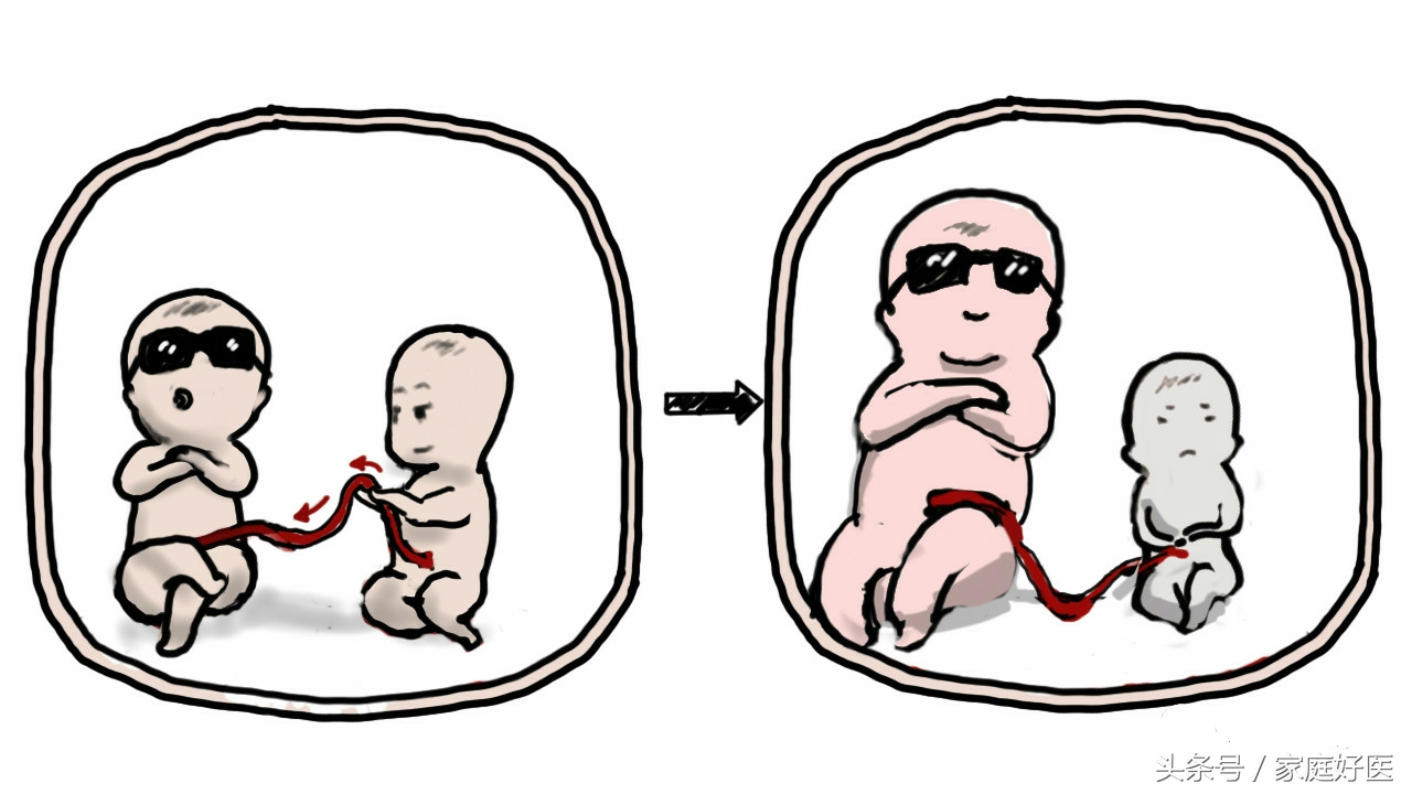 怀双胞胎一个会被另一个吸收吗,双胞胎吃掉另一个胎儿