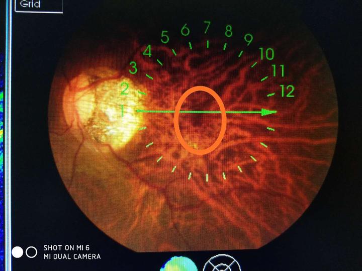 玩手机游戏高度近视,高度近视黄斑水肿出血怎么治疗