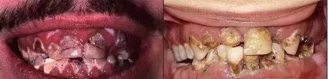 这一口烂牙，就能让你意识到*品毒**的破坏力有多恐怖