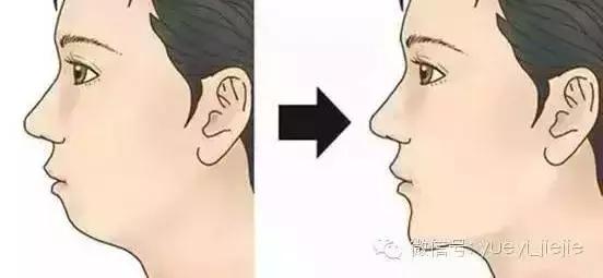 下巴填充和假体植入哪个好,下巴填充膨体跟硅胶哪个更好