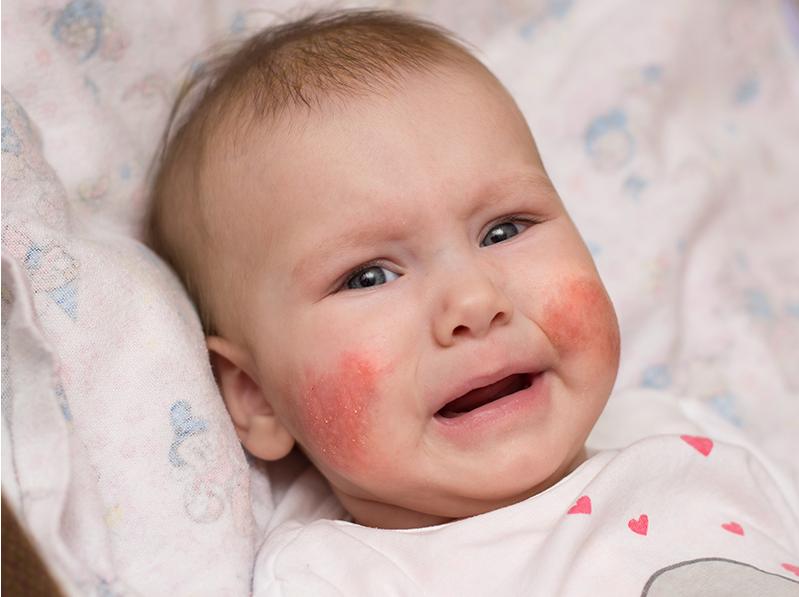 最近宝宝脸上起红疹子怎么办,宝宝脸上起红疹怎么办