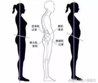 长期久坐骨盆前倾最快矫正法,如何改善久坐骨盆前倾