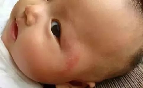 秋季孩子身上痒是什么原因,秋季宝宝身上起红疙瘩越挠越痒