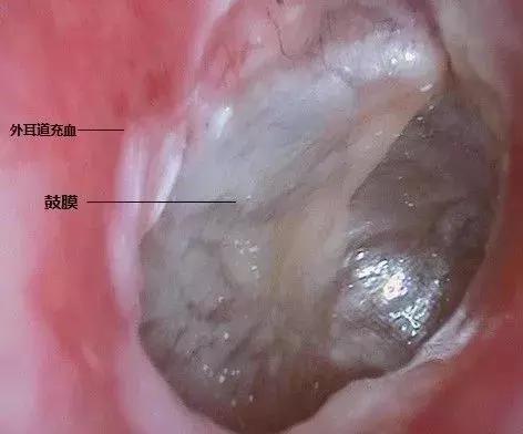 儿童洗澡耳朵进水会导致中耳炎吗,耳朵进水引起中耳炎引起耳鸣