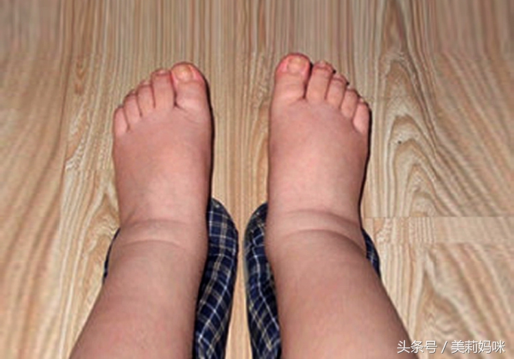 水肿一般在临产前多少周,临产前征兆攻略