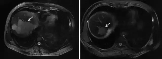放疗疗效,放疗效果如何体现