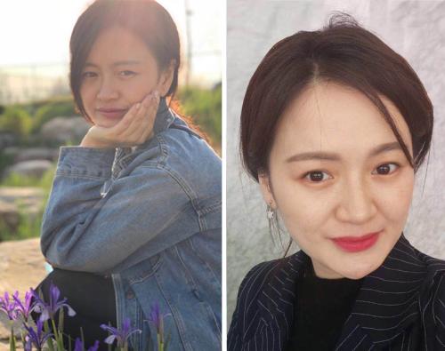 做完双眼皮的真实感受,双眼皮术后20天感觉眼睛变小了