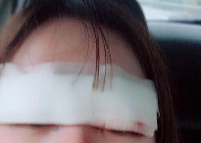 微创双眼皮开眼角3680元贵吗,纳米无痕双眼皮开眼角操作全过程