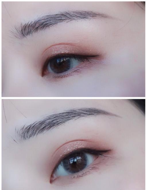 微创双眼皮开眼角3680元贵吗,纳米无痕双眼皮开眼角操作全过程