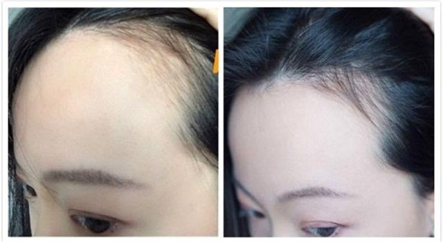 目前防脱生发最好的产品,好用洗护套装防脱发