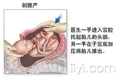 剖腹产,剖腹产3d动画演示