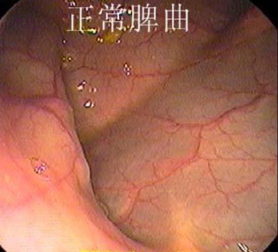 正常肠镜报告单图片大全,正常肠道的肠镜图片