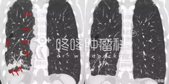 奥希替尼耐药六大最新处理方案 (奥希替尼缓慢耐药后续如何处理)