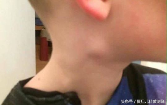 宝宝脖子上有个小疙瘩是什么,四个月宝宝脖子两侧摸着有小疙瘩