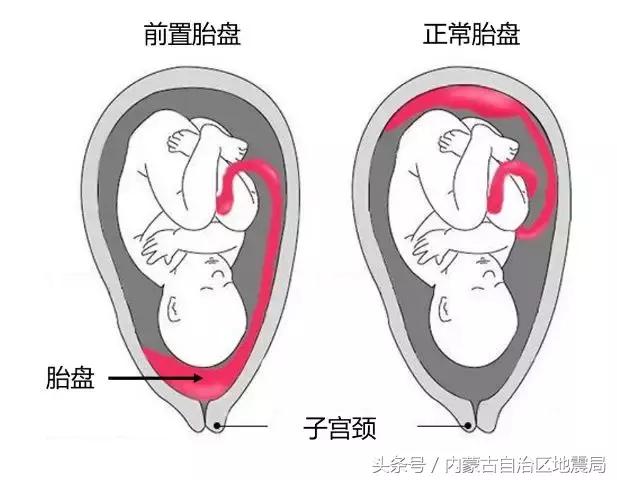 剖宫产还是顺产到底该如何选择,剖宫产好还是剖腹产好