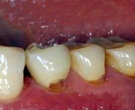 生活中常见的10大伤牙习惯，你中招了几个？