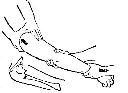 中医骨折治疗原则,中医骨伤整复术