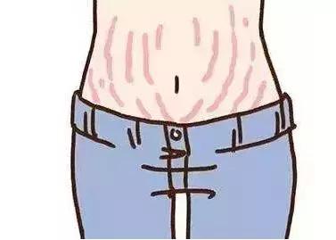 妊娠纹海兰,妊娠纹被嫌弃自救