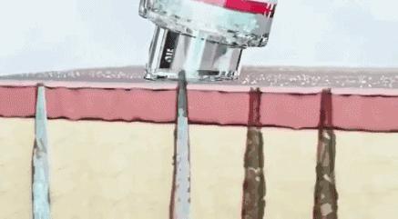 去黑头收缩毛孔的正确方法实测,严重黑头毛孔粗大怎么去除最有效