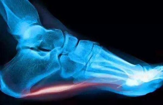 脚后跟长骨刺非常痛应该怎么治疗,脚后跟长骨刺了特别疼怎么治疗