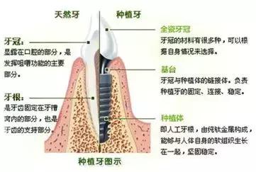 3颗牙连在一起多少钱,3颗牙齿需要多少费用
