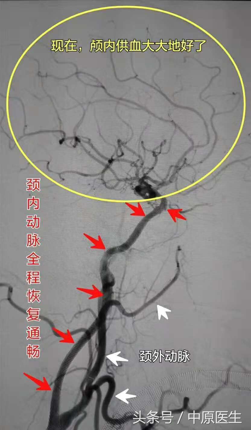 53岁男子脑梗急救室抢救真实纪实,脑动脉闭塞介入治疗视频