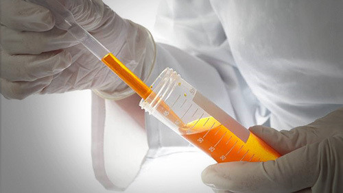 引起血尿的疾病及发病机制,引起血尿的原因有哪些