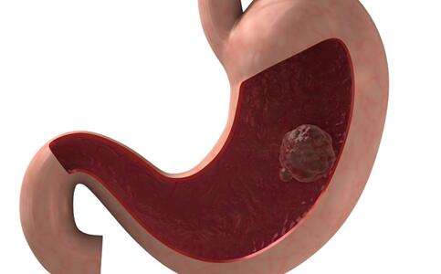 12个最能迷惑人的癌症前兆,10种常见癌症的症状表现记得收藏