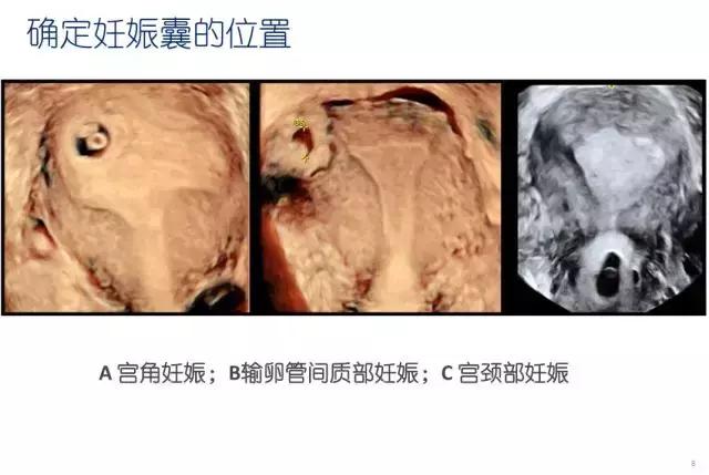 妇科盆腔彩超探头,妇科超声波探头