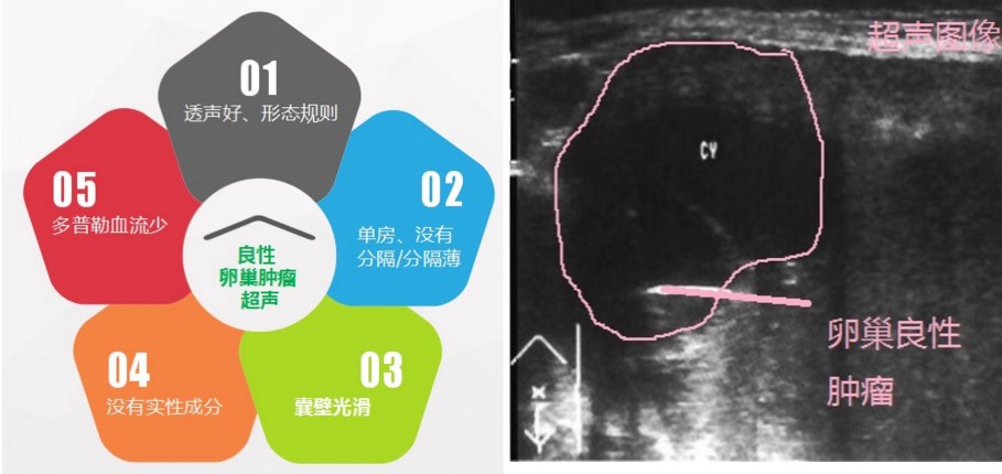 卵巢囊肿是良性的还用不用切卵巢,怎么判断卵巢囊肿良性还是恶性