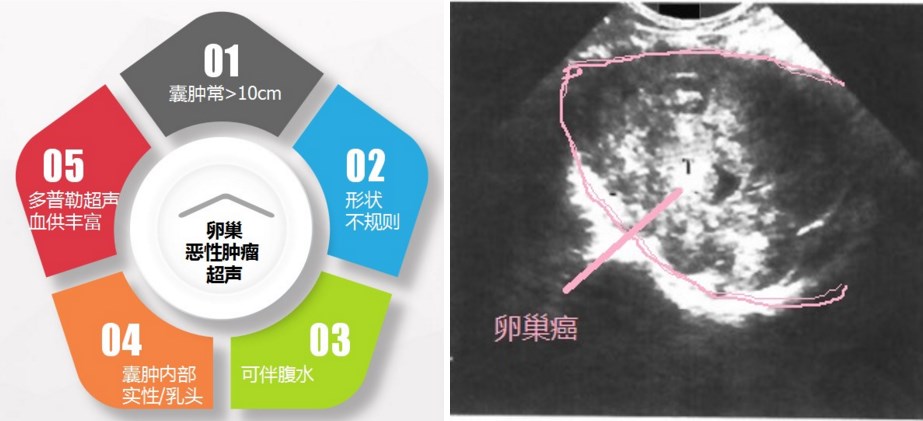 卵巢囊肿是良性的还用不用切卵巢,怎么判断卵巢囊肿良性还是恶性