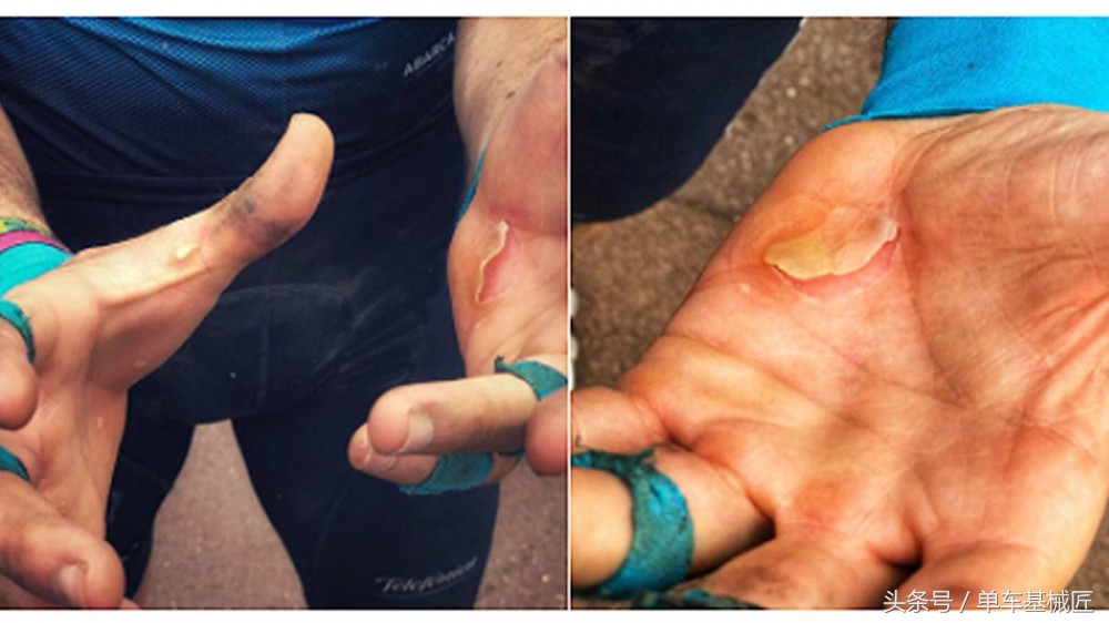 骑自行车磨出了水泡多久自愈,骑行脚上会磨出水泡吗