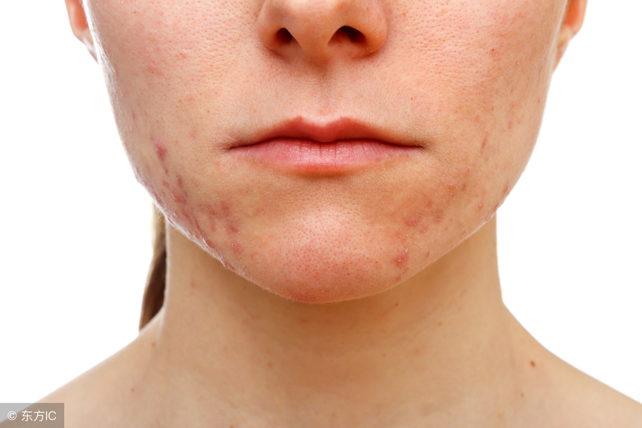 下巴狂冒粉刺，是荷尔蒙分泌出问题？改善粉刺问题有5大保养诀窍