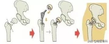 老年人的最后一次骨折,老年人请谨防人生最后一次骨折
