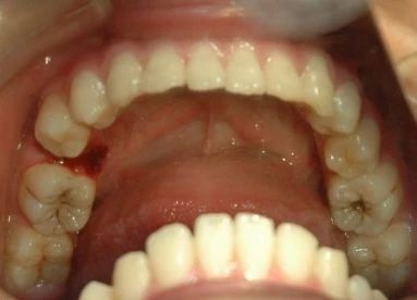 拔完牙最怕并发症,拔完牙之后的最严重的并发症