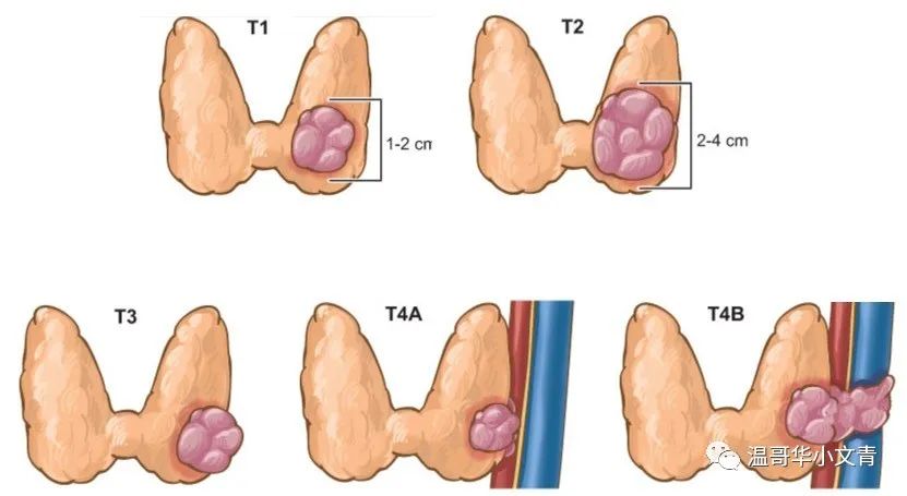 分化型甲状腺癌的分期及生存率,如何判定得了甲状腺癌