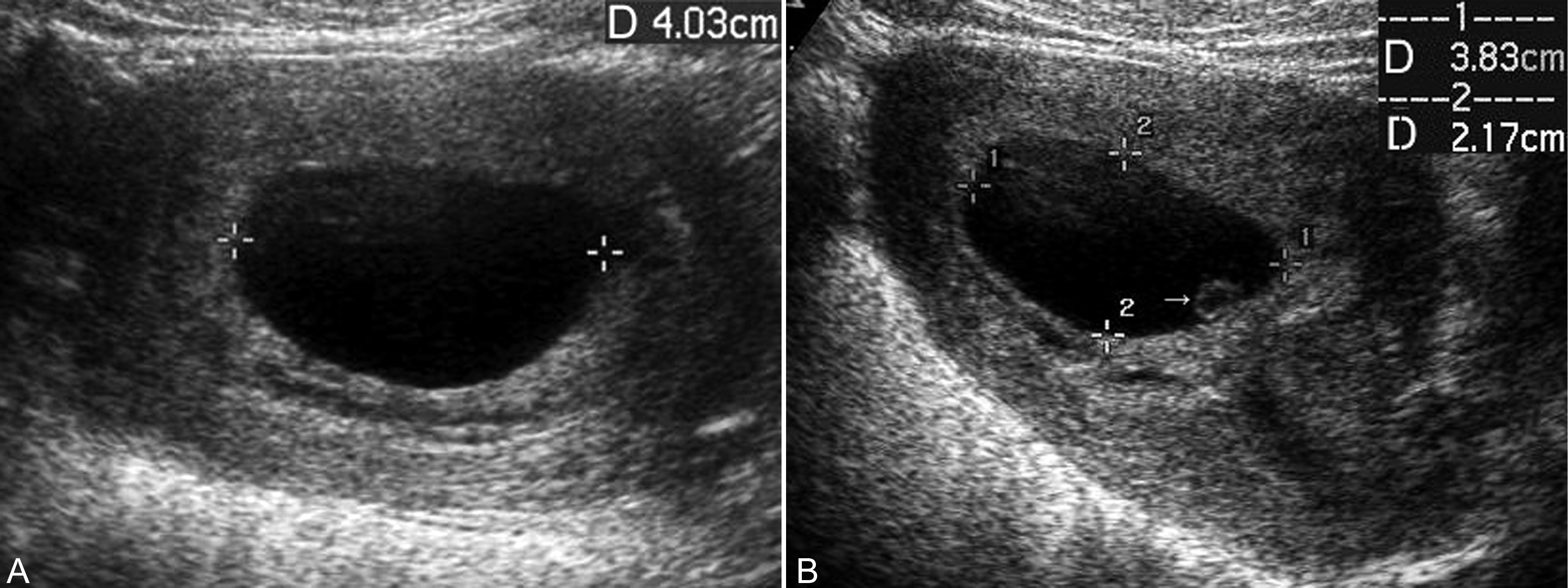 明明白白做超声32-3:流产:超声检查