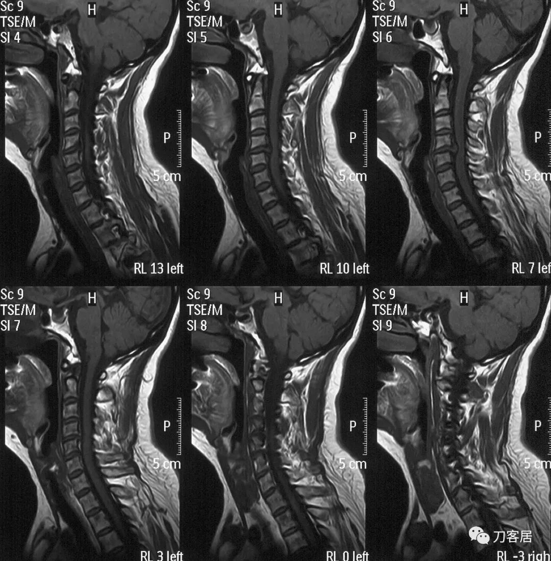 脊髓型颈椎病手术后多少天能出院,脊髓型颈椎病手术几天出院