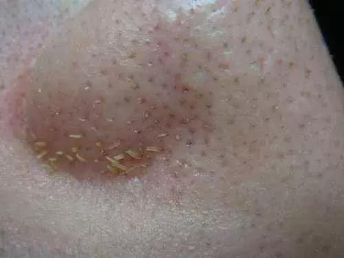 你知道黑头是怎么形成的吗,怎么分辨黑头的严重程度