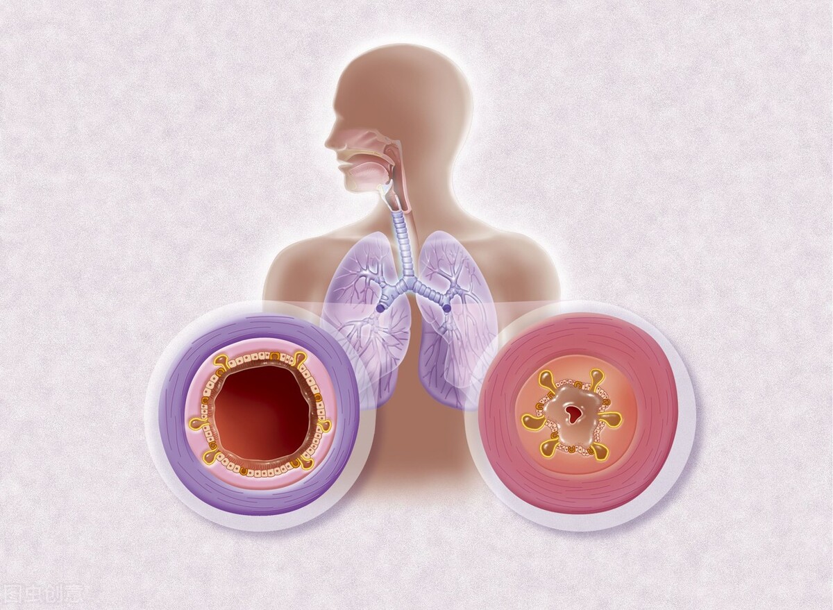 慢性支气管炎引起气喘怎么办,气喘咳嗽慢性支气管炎吃什么药