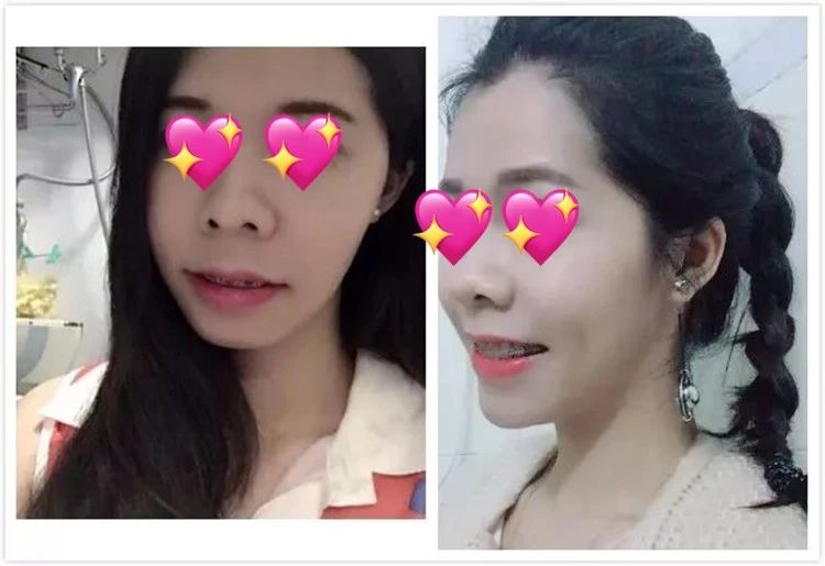 整牙齿堪比整容,矫正牙齿大概多少钱龅牙