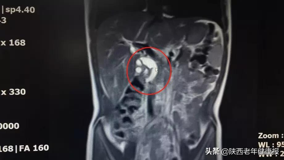 补神来了|经常“胃痛”？小心“伪装高手”胰腺疾病在作怪