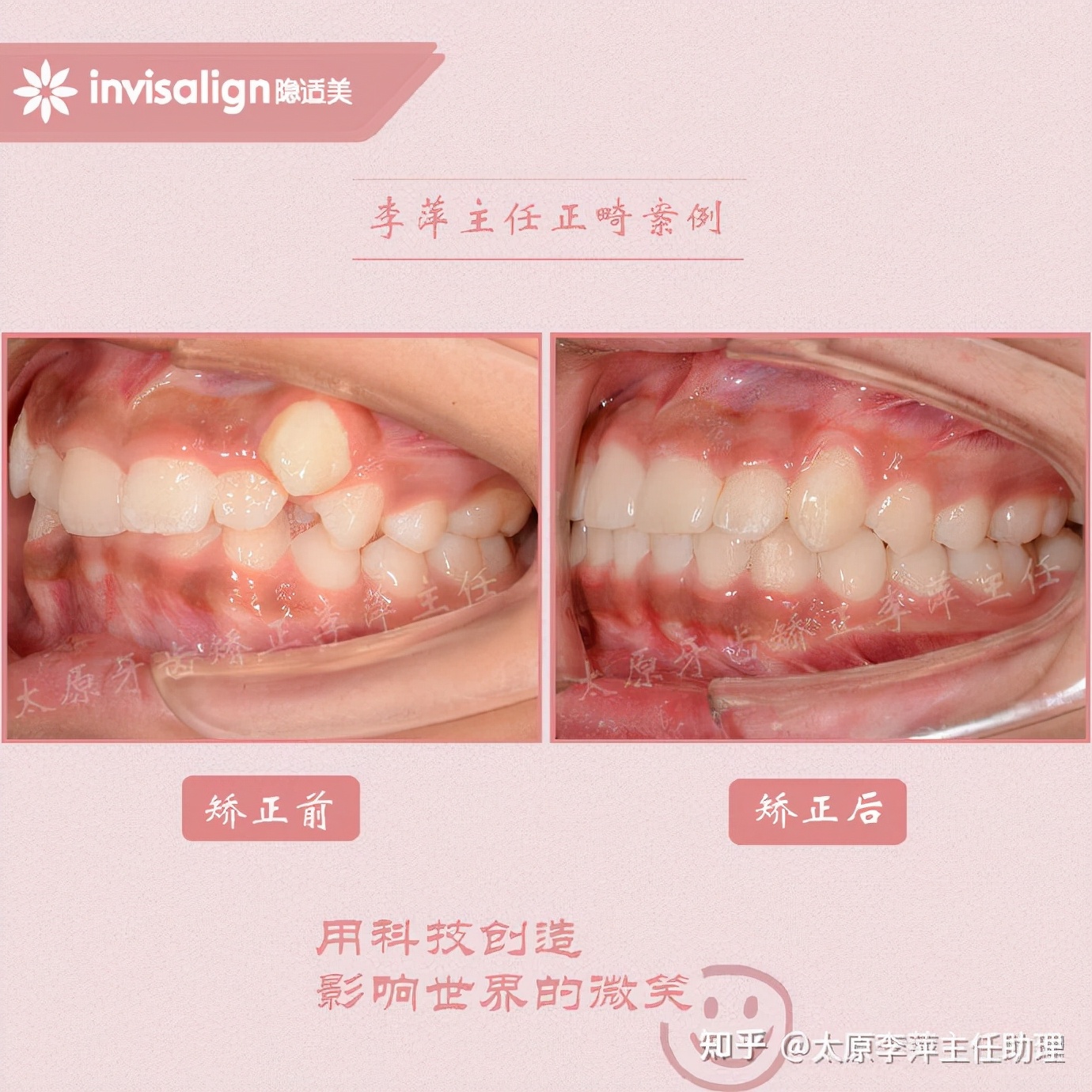太原牙齿矫正靠谱吗,太原成人隐形牙套牙齿不齐