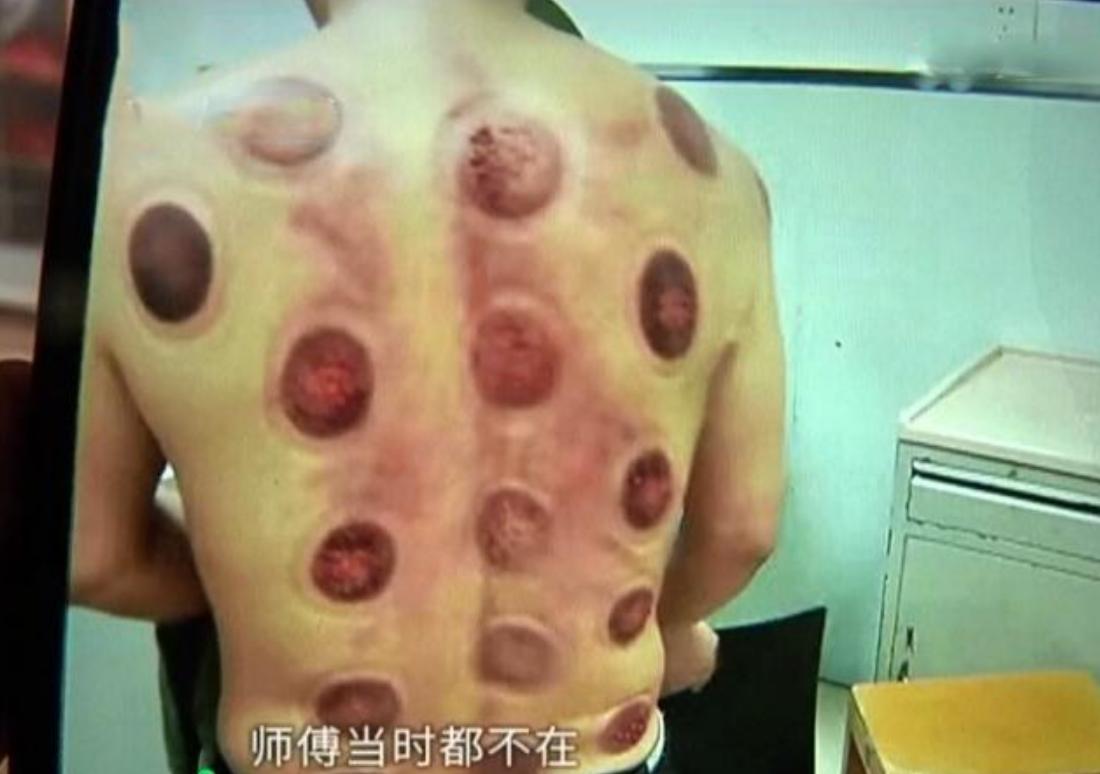 洗澡拔罐刺痒,洗浴中心洗澡后拔罐