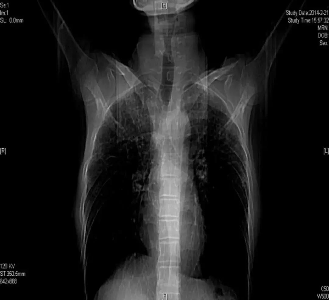 肺纤维化病例,肺纤维化手指甲发紫还能活多久