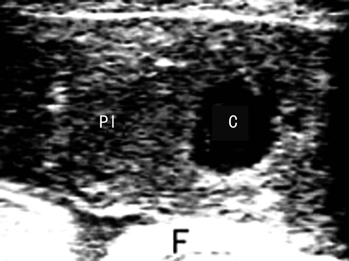 胎盘异常的超声表现,胎盘的异常超声