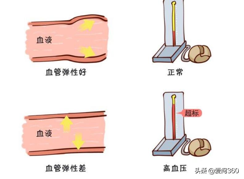 血管没有弹性什么原因该怎么治,血管失去弹性与血虚有关吗
